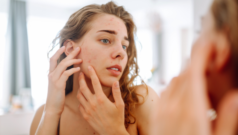 Kobieta z trądzikiem hormonalnym ogląda swoją twarz w lustrze – objawy zaburzeń hormonalnych widoczne na skórze.